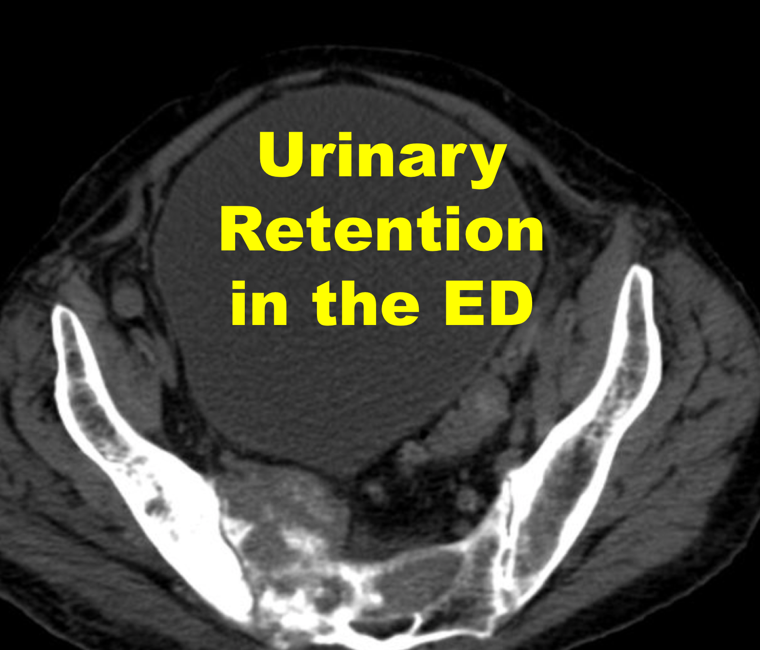 Doc I Can’t Pee, What Could It Be? Evaluation and Management of Acute