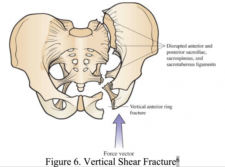 Emergency Medicine EducationPelvic fractures ED