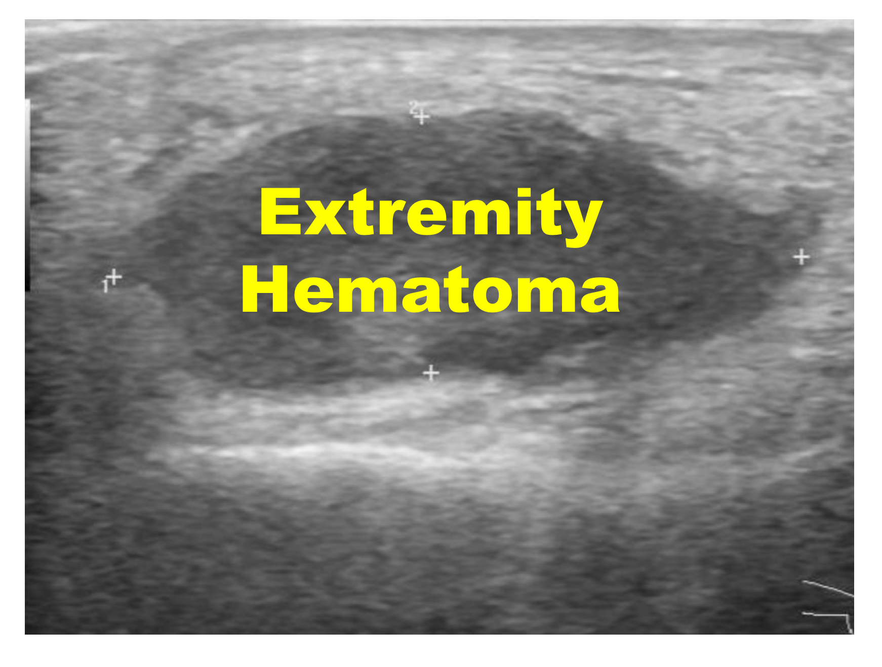 emDOCs.net – Emergency Medicine EducationExtremity Hematoma: When to