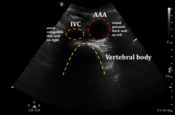 ultrasound diagnostics of the abdominal aorta)
