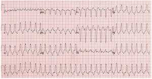Emdocs Net Emergency Medicine Educationventricular Tachycardia