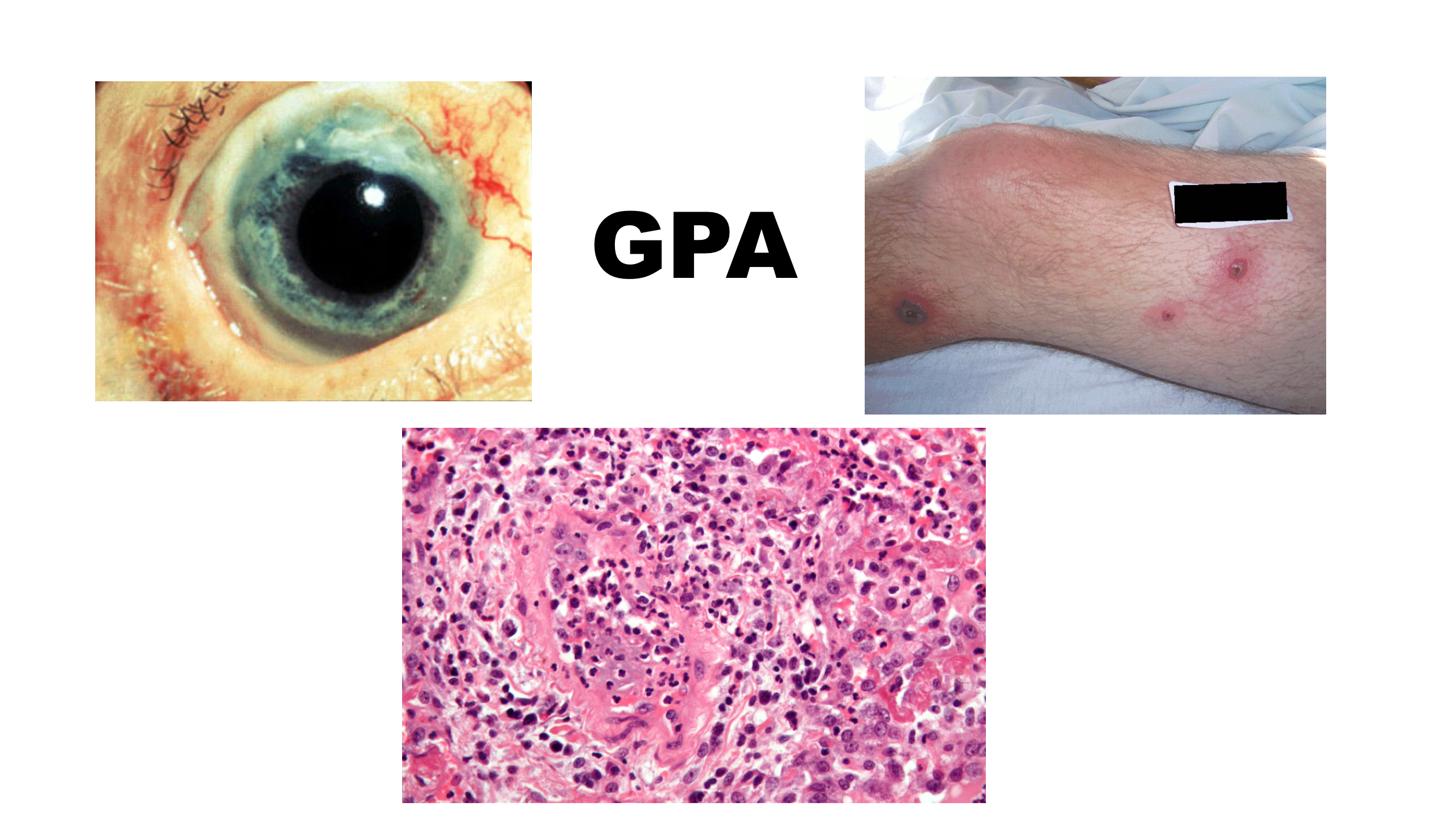 EmDOCs Emergency Medicine Educationvasculitis Archives EmDOCs emdocs-emergency-medicine-educationvasculitis-archives-emdocs