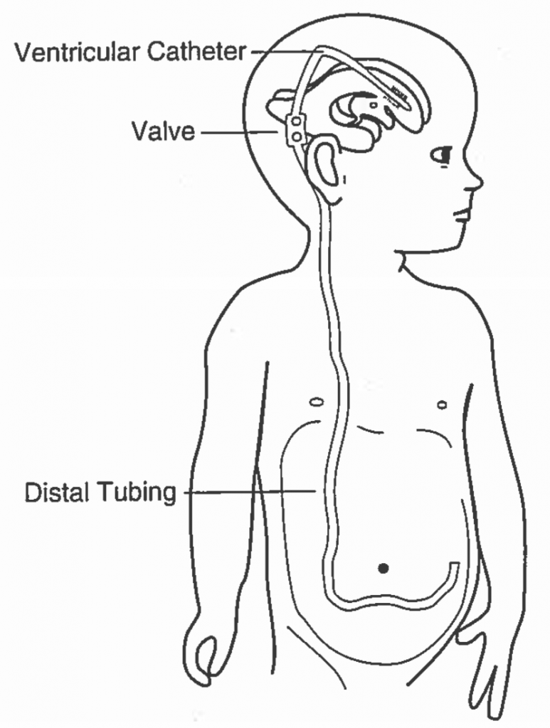 Emergency Medicine of CSF Shunts