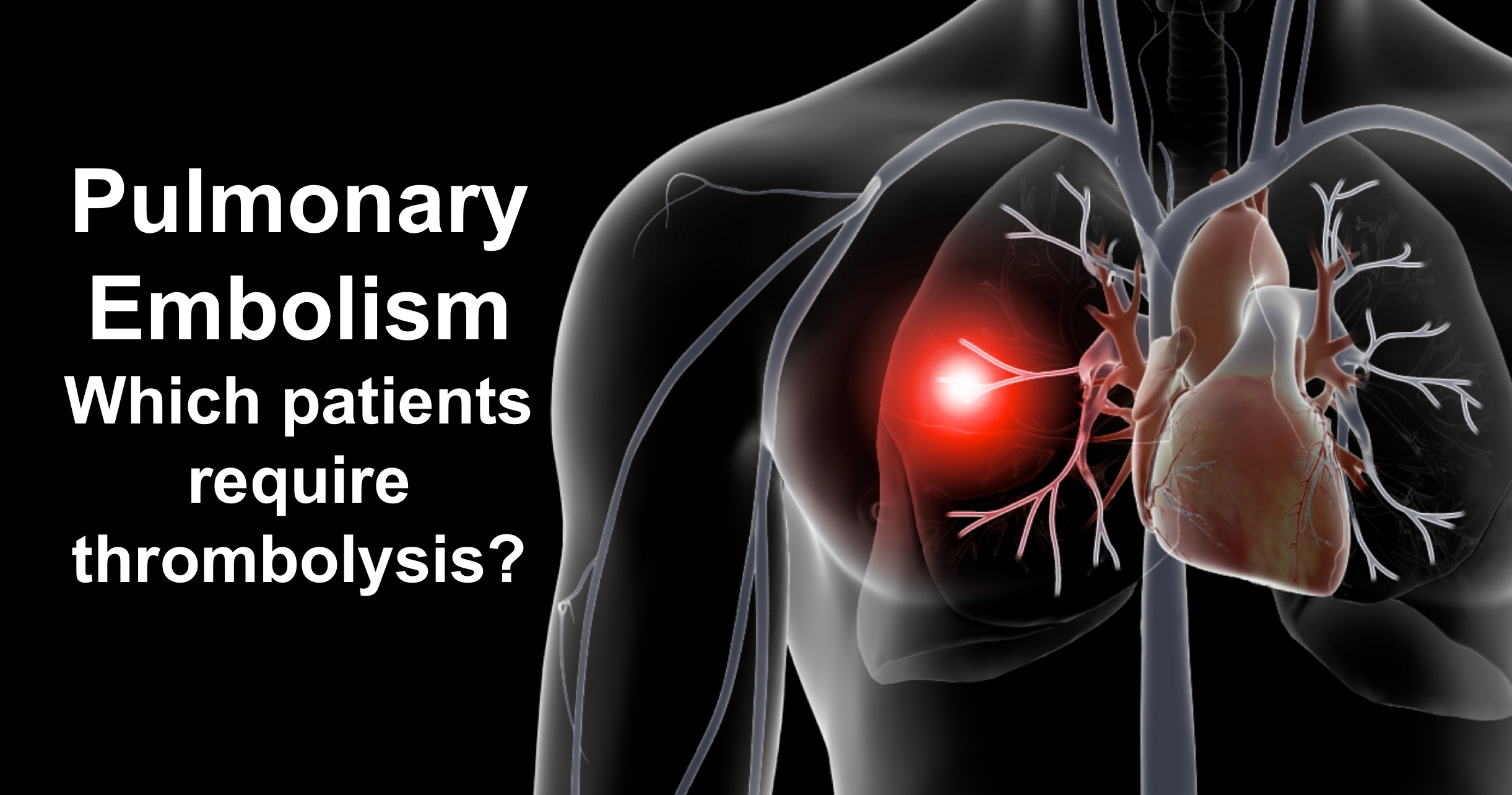 Emergency Medicine Educationpulmonary embolism Archives Emergency