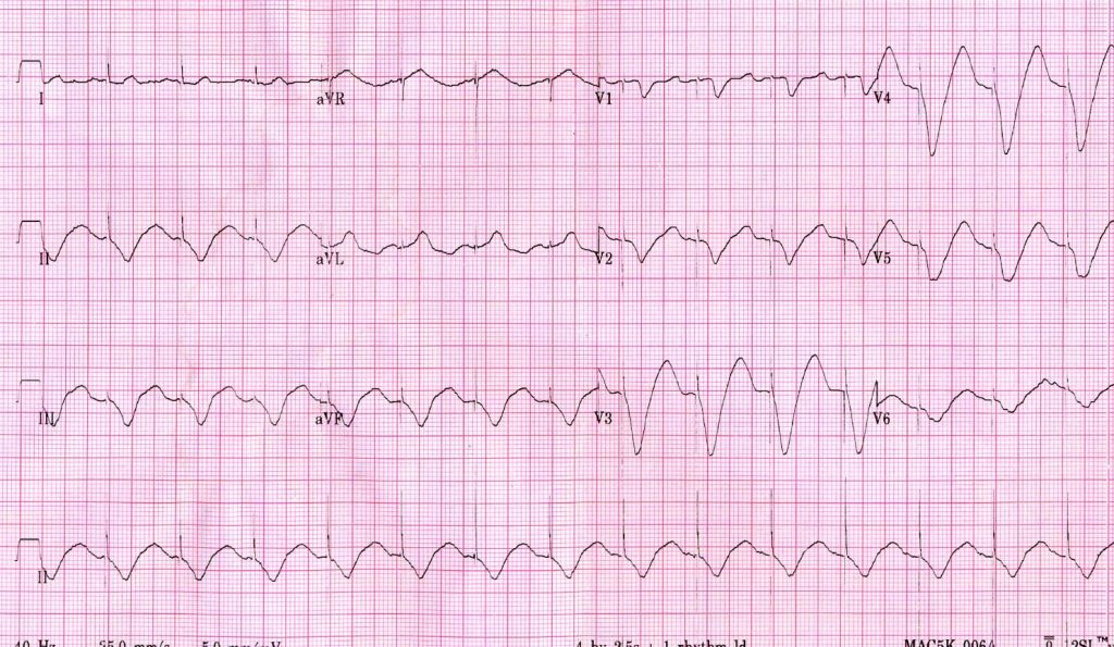 a hipertónia megjelenik-e az EKG-n