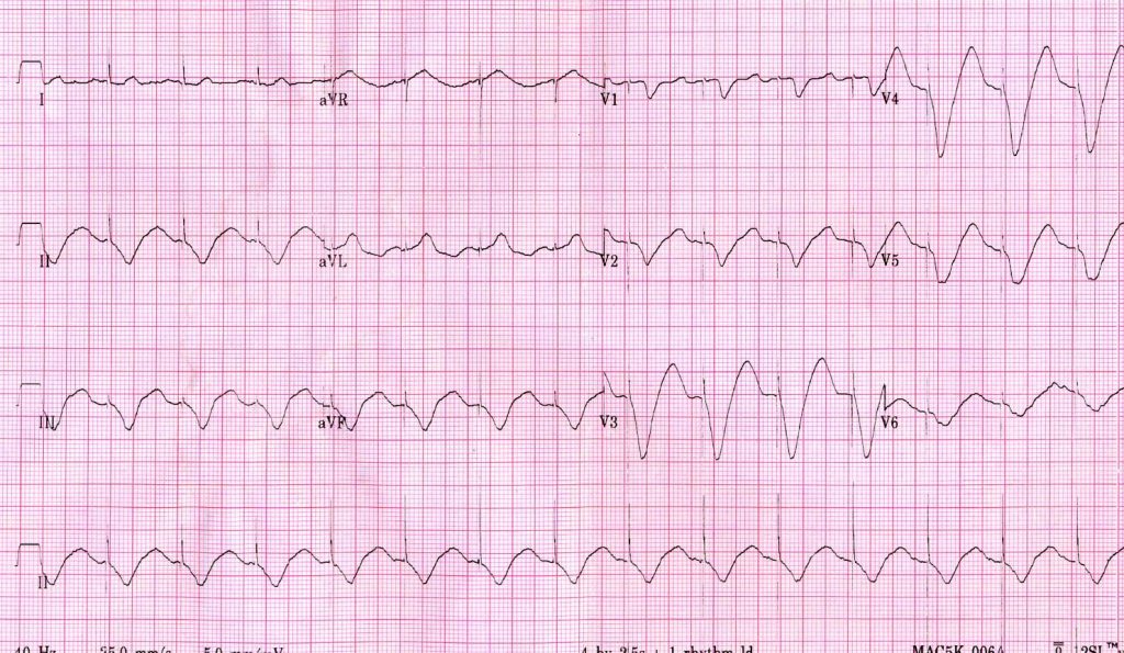 a hipertónia megjelenik-e az EKG-n)