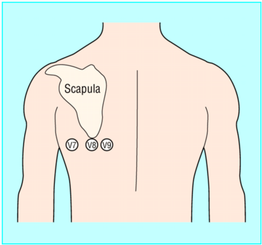 Emergency Medicine EducationECG Pointers Posterior MI