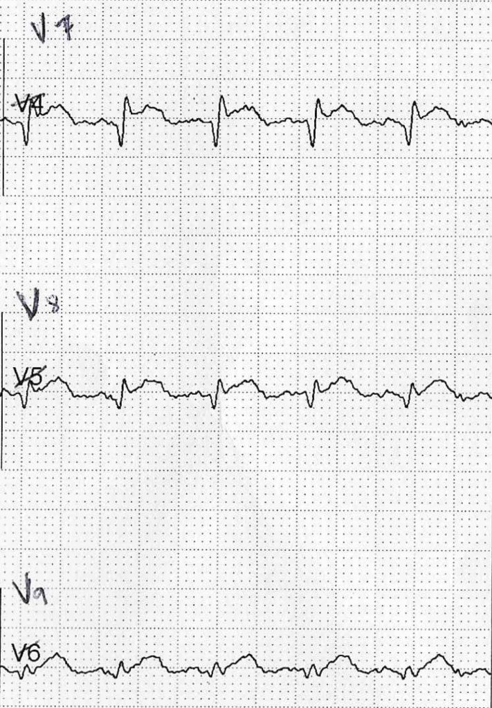 Emergency Medicine EducationECG Pointers Posterior MI
