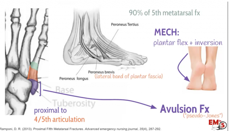 fifth metatarsal fracture treatment and tips fifth metatarsal fracture treatment and tips