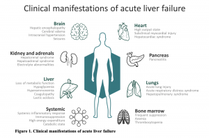 Emdocs Net Emergency Medicine Educationacute Liver Failure Evidence Based Evaluation And Management Emdocs Net Emergency Medicine Education