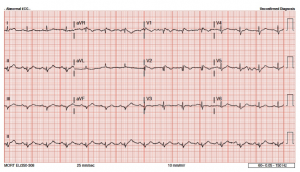 Emdocs Net Emergency Medicine Educationecg Pointers Pseudobrugada Pattern Emdocs Net Emergency Medicine Education
