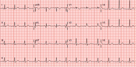 ECG Pointers: Syncope and Wolff-Parkinson-White