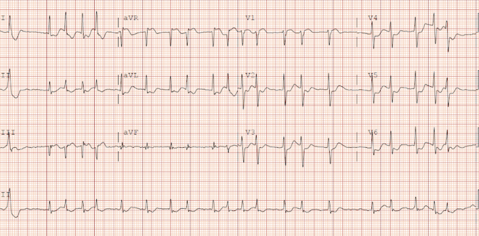 Emergency Medicine EducationECG postROSC