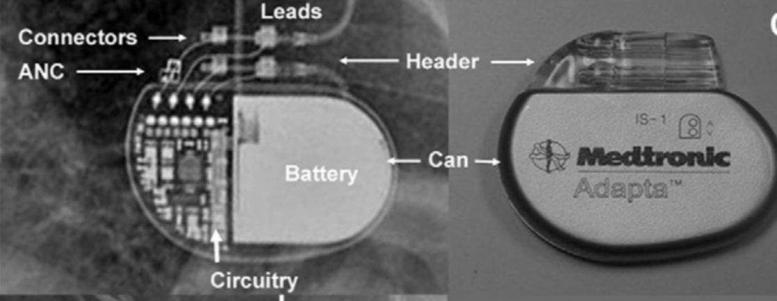 ECG Pointers: Pacemakers… and when they malfunction