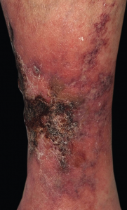 Calciphylaxis: An Ominous Skin Condition You Should Know About
