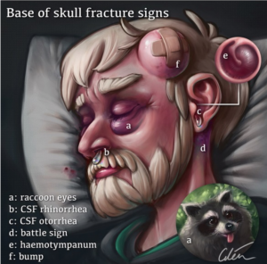 Recovery time fracture skull Skull Fractures: