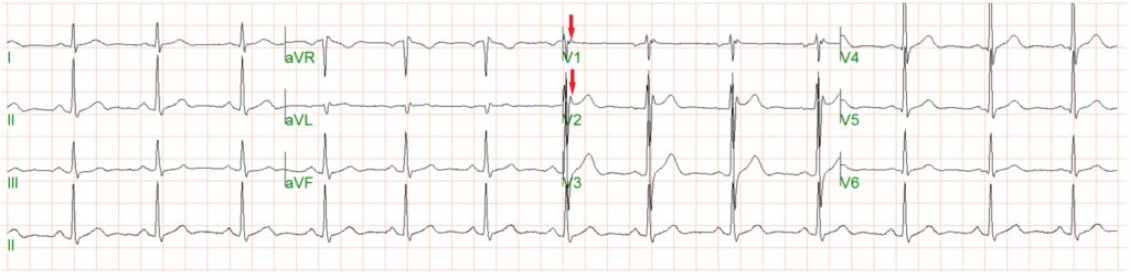 ECG Pointers: Syncope and Arrhythmogenic Right Ventricular Cardiomyopathy