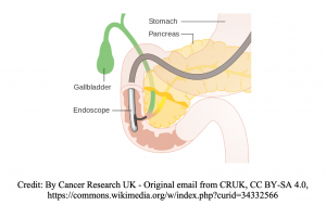 pancreatic cancer ercp