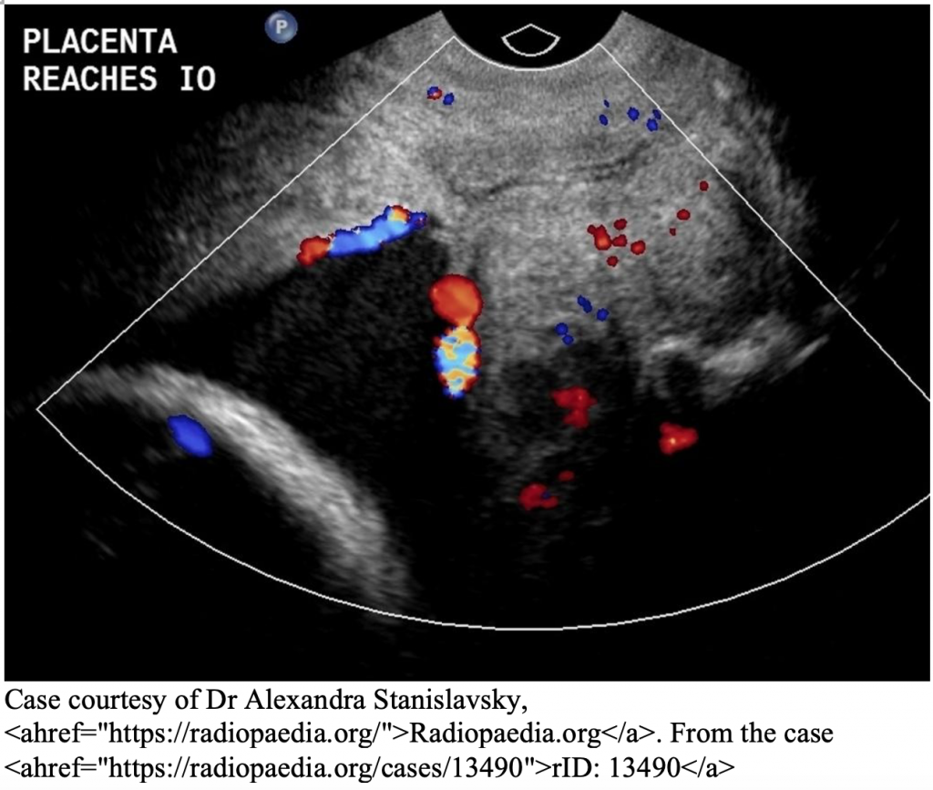 Emergency Medicine EducationEM3AM Placenta Previa