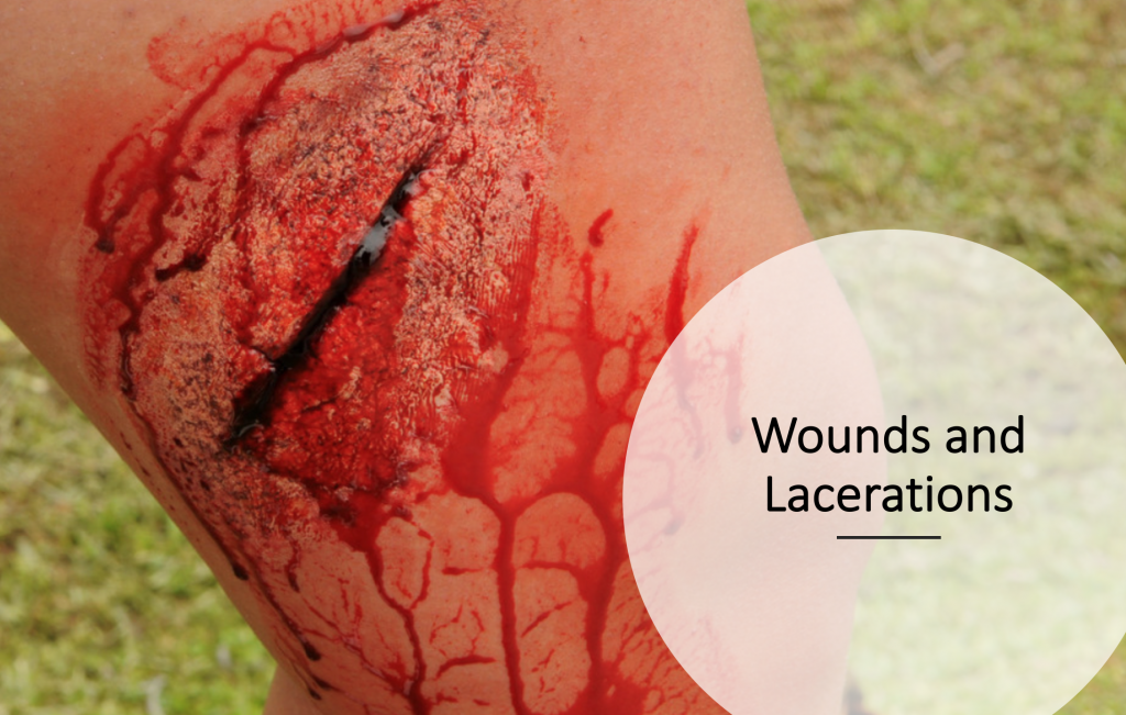 Laceration - Chin (After Skin Glue)
