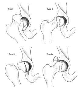 Medical Malpractice Insights: Fracture/dislocation of hip results in avascular necrosis