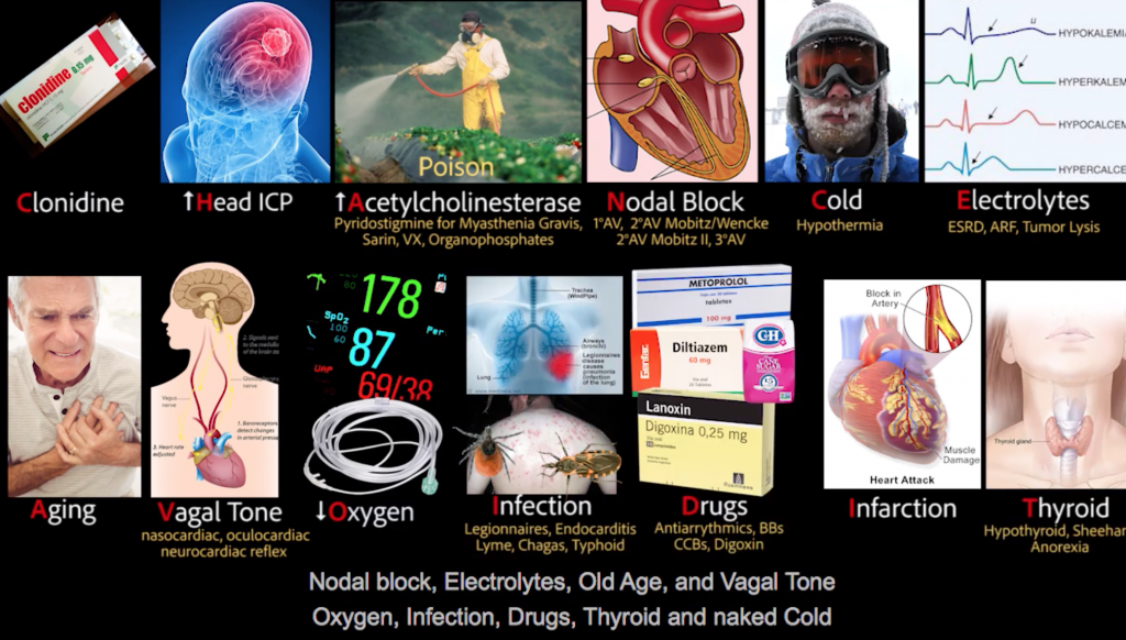 Cleavon MD: Bradycardia DDX