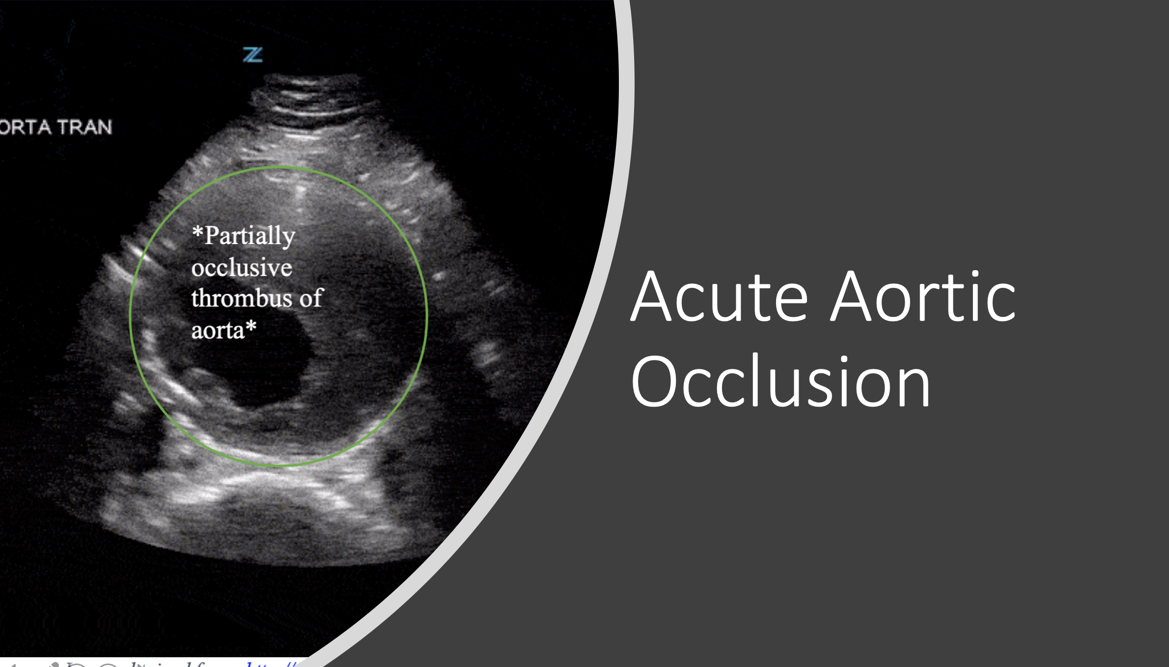 Emergency Medicine EducationAcute Aortic Occlusion