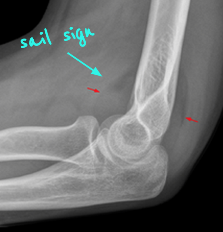 Emergency Medicine EducationEM in 5 Elbow Xrays emDOCs