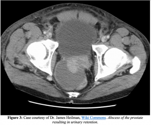 prostatitis diagnosis ct scan)