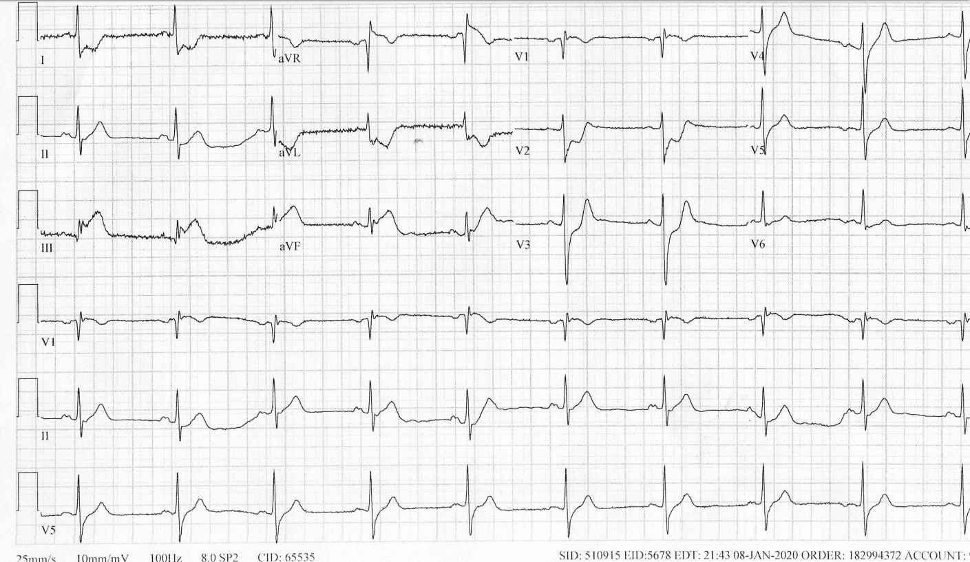 ECG Pointers: Post Myocardial Infarction Complications – Stent Thrombosis