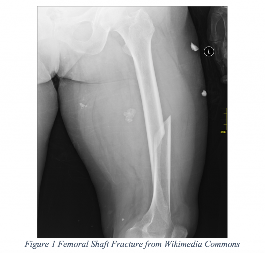 EmDOCs Emergency Medicine EducationFracture Radiographs A Rapid