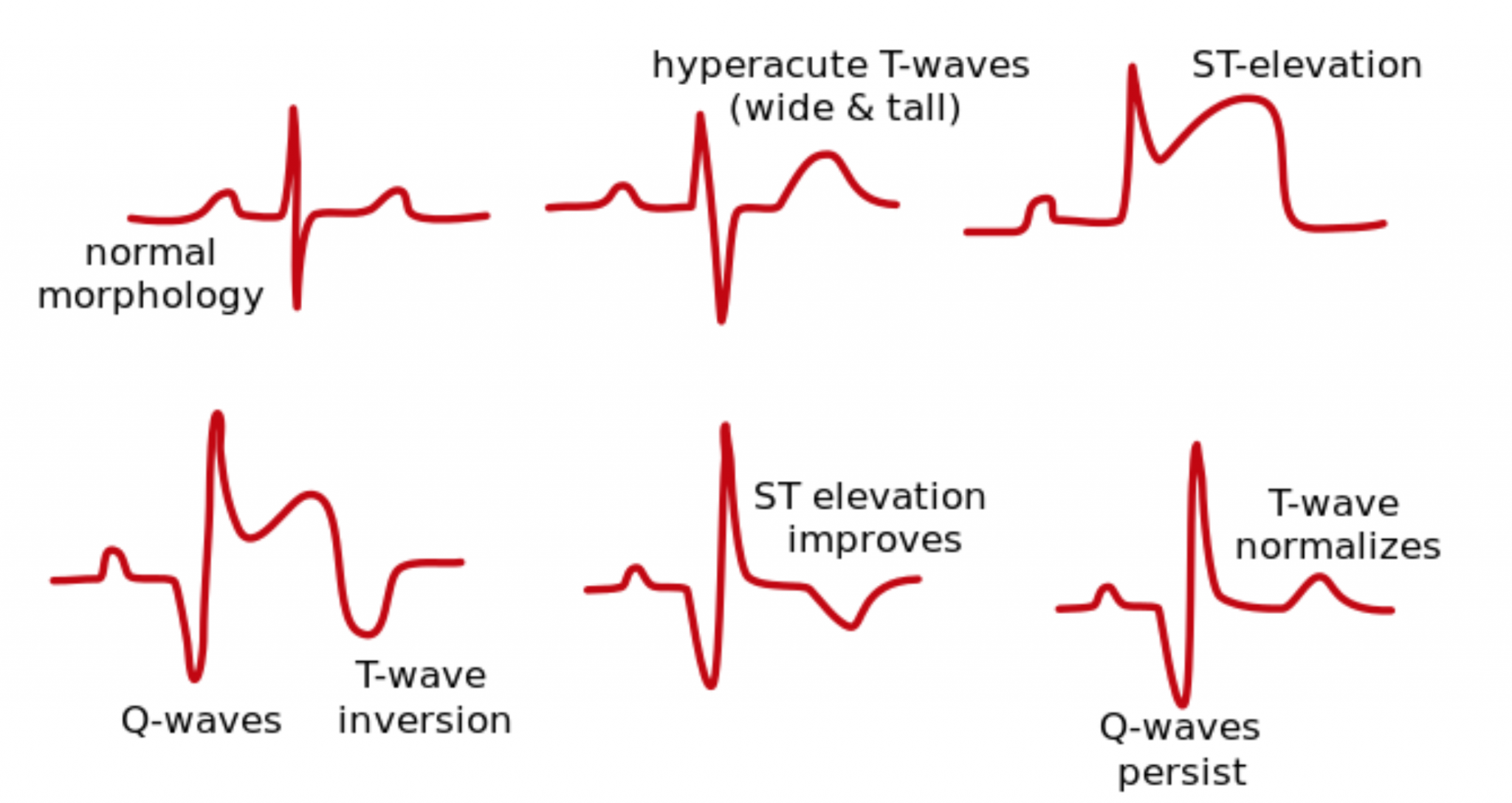 Electric Shock Ecg Changes At Hunter Sachse Blog