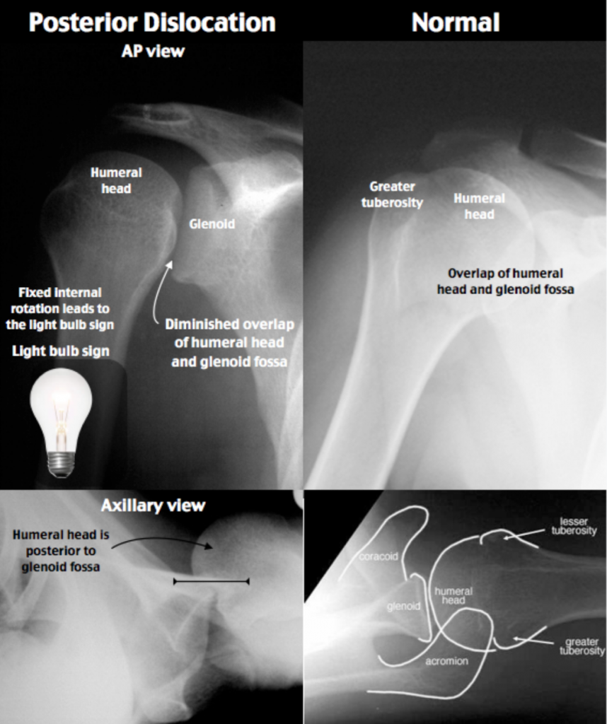 Emergency Medicine EducationEM3AM Anterior Shoulder