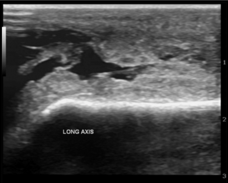 Septic Bursitis ED Presentation, Evaluation, and Management