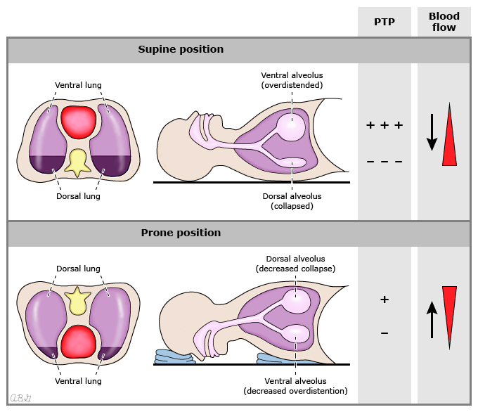 Prone positioning reduces the difference between the dorsal and ventral PTP, making ventilation more homogeneous, leading to a decrease in dorsal alveolar overinflation and ventral alveolar collapse and recruitment of alveoli that had collapsed during the supine ventilation. Prone positioning also reduces the difference between the dorsal and ventral PTP, making ventilation more homogeneous, leading to a decrease in dorsal alveolar overinflation and ventral alveolar collapse and recruitment of alveoli that had collapsed during the supine ventilation.