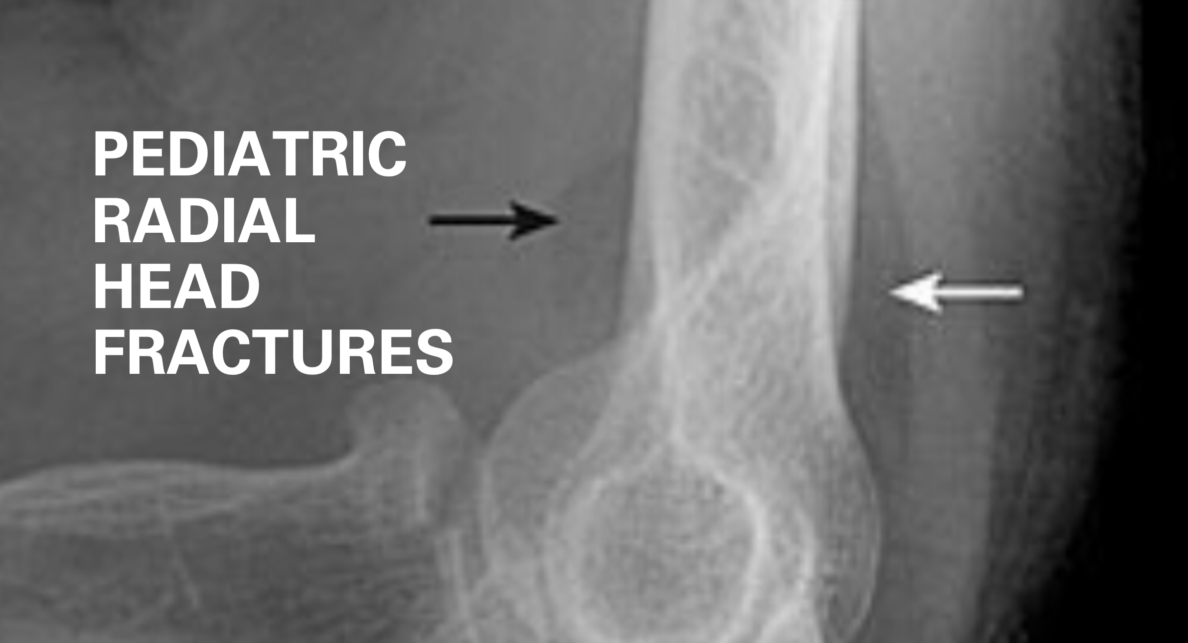 Emdocs Net Emergency Medicine Educationpediatric Radial Head Fractures Special Considerations