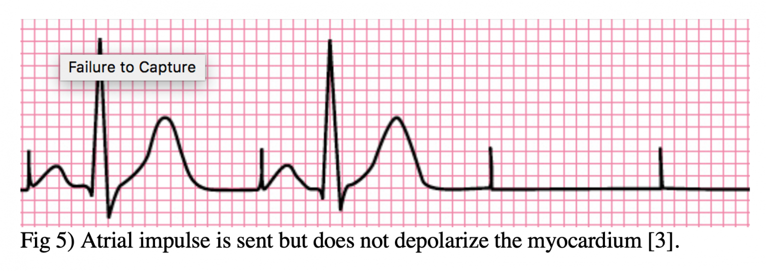 Emergency Medicine EducationEM3AM Pacemaker/AICD