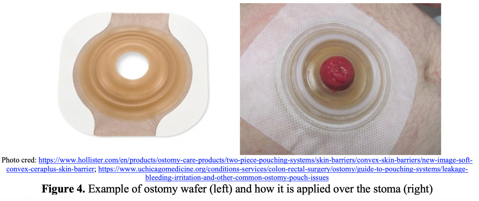 Ostomy complications ED presentations, complications, and management