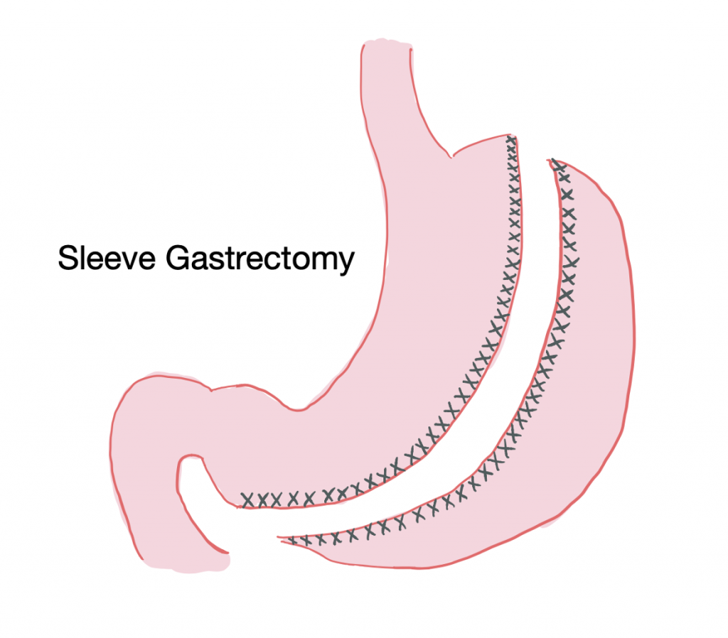 Emergency Medicine of Bariatric