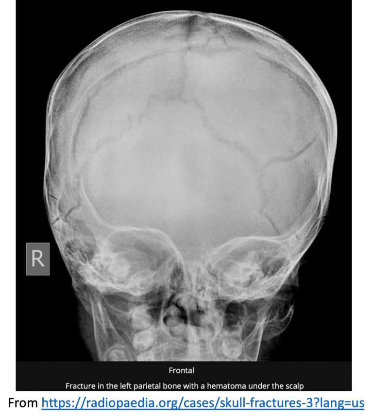 Emergency Medicine EducationBursting at the Skull Skull Fractures