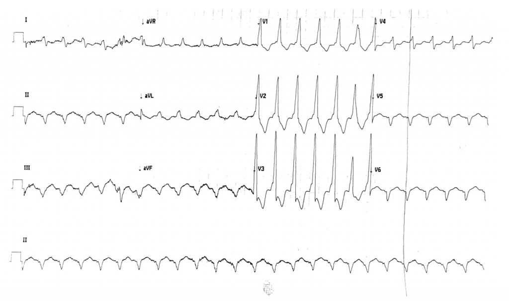 Emergency Medicine EducationECG Pointers The Lewis Lead