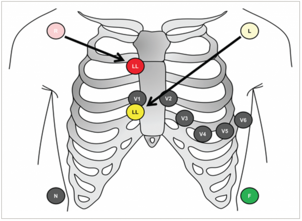 Emergency Medicine EducationECG Pointers The Lewis Lead