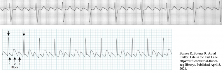 typical atrial flutter icd 10