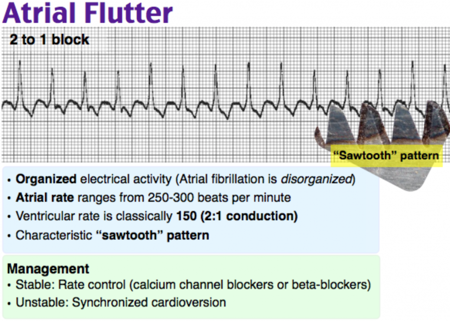 atrial flutter vs svt atrial flutter vs svt