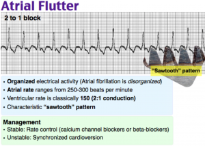 atrial flutter causes during pregnancy atrial flutter causes during pregnancy