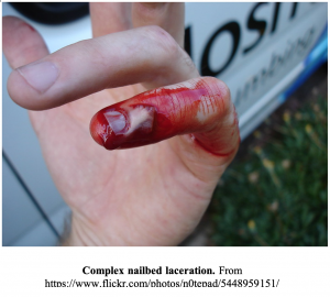  – Emergency Medicine EducationEvidence-based Approach to Nailbed  Injuries: ED Presentations, Evaluation, and Management  -  Emergency Medicine Education