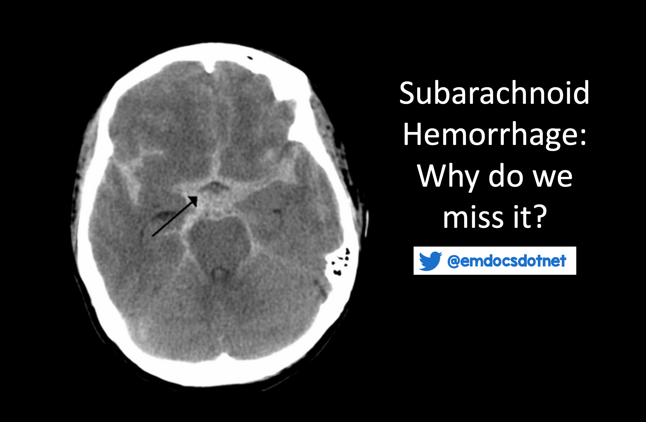 Subarachnoid Hemorrhage (SAH) - Brain, Spinal Cord, and Nerve