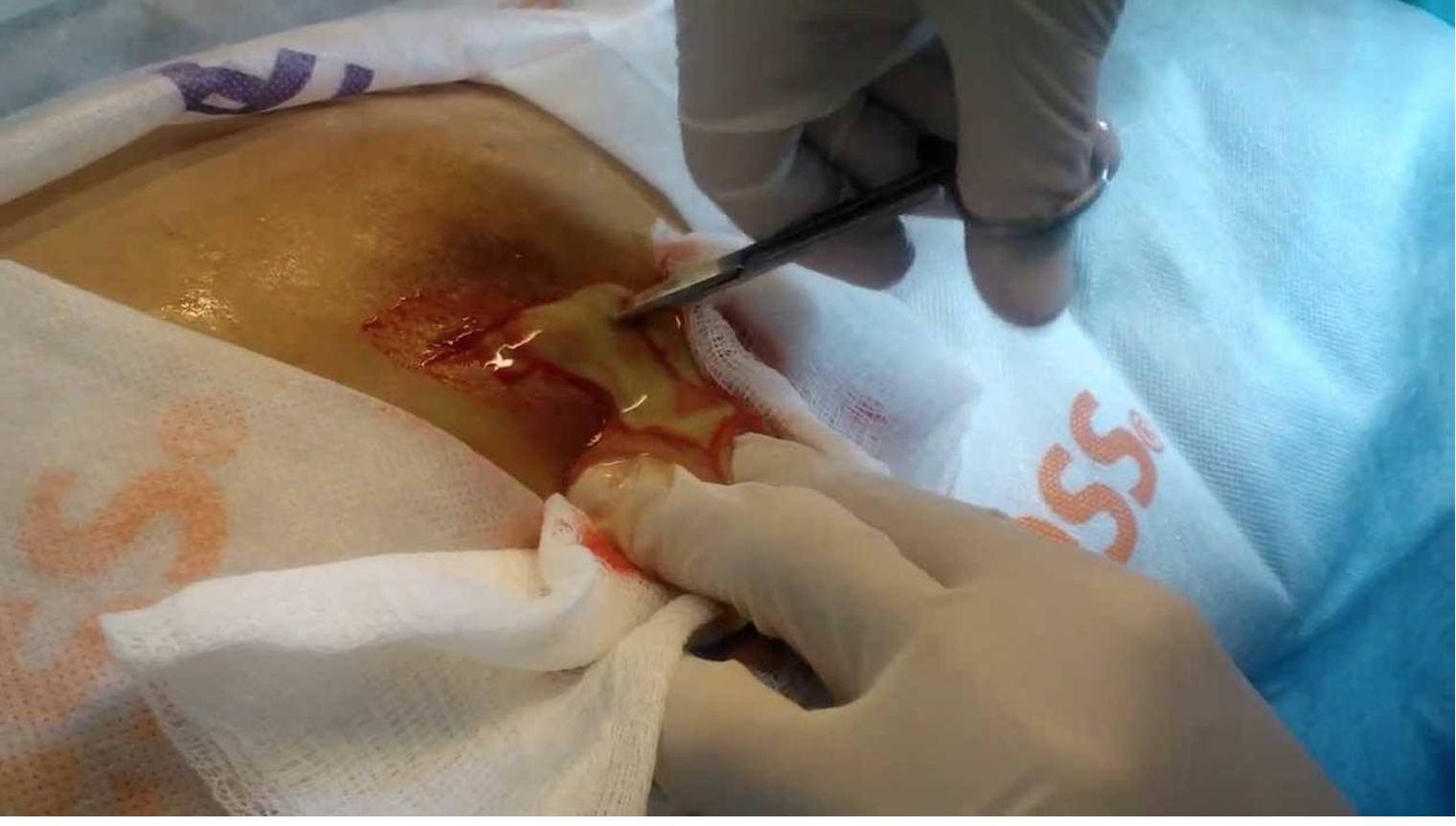 Medical Malpractice Insights: Major hemorrhage after I & D of axillary abscess
