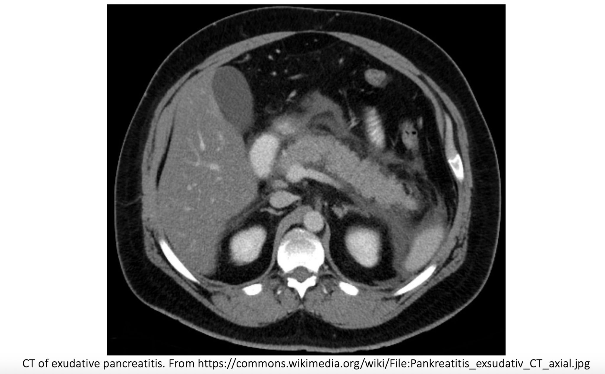 Evidence-Based Disposition of Acute Pancreatitis