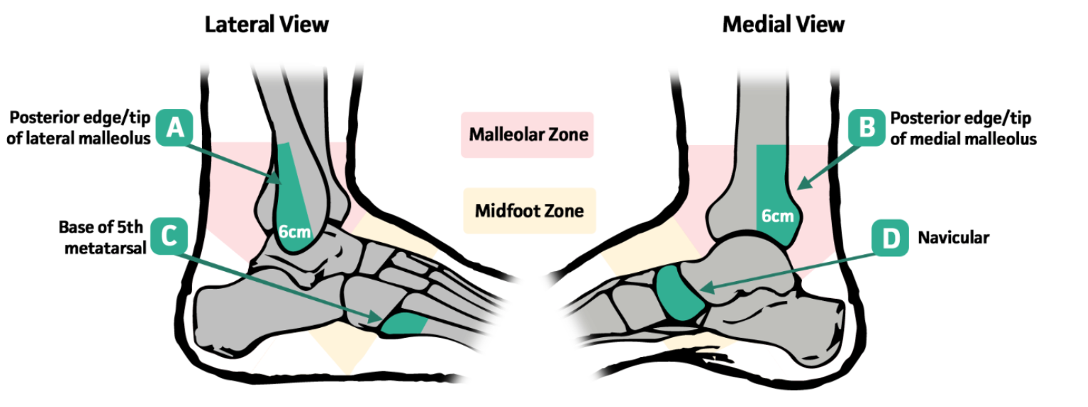 Medical Malpractice Insights: Ottawa Ankle/Foot Rule